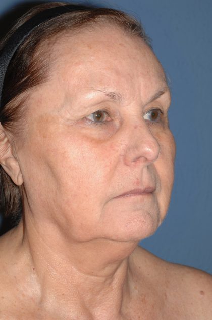 Upper & Lower Facelift - Brow Lift & Face/Neck Lift Before & After Patient #8301