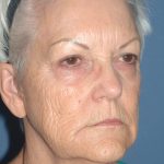 Upper & Lower Facelift - Brow Lift & Face/Neck Lift Before & After Patient #8302