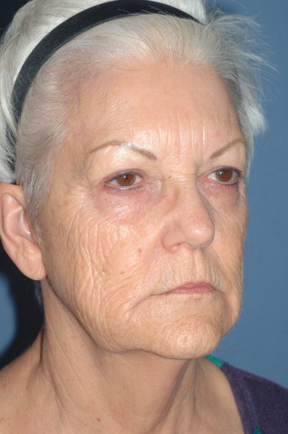 Upper & Lower Facelift - Brow Lift & Face/Neck Lift Before & After Patient #8302