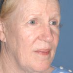 Upper & Lower Facelift - Brow Lift & Face/Neck Lift Before & After Patient #8303