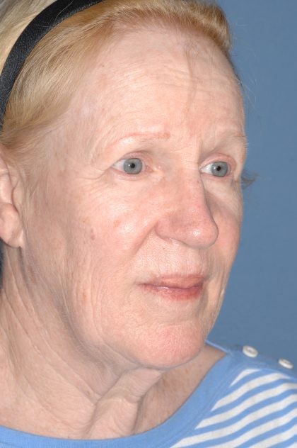 Upper & Lower Facelift - Brow Lift & Face/Neck Lift Before & After Patient #8303