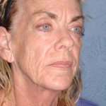 Upper & Lower Facelift - Brow Lift & Face/Neck Lift Before & After Patient #8304