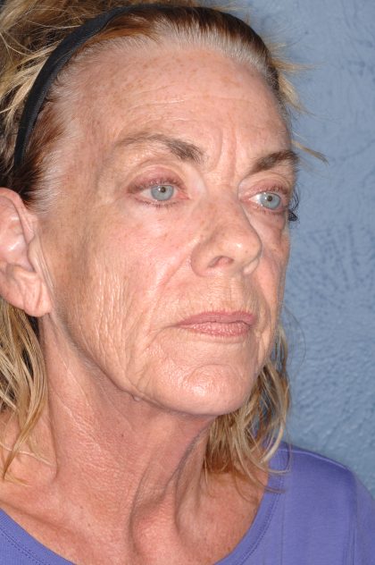 Upper & Lower Facelift - Brow Lift & Face/Neck Lift Before & After Patient #8304