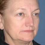 Upper & Lower Facelift - Brow Lift & Face/Neck Lift Before & After Patient #8305