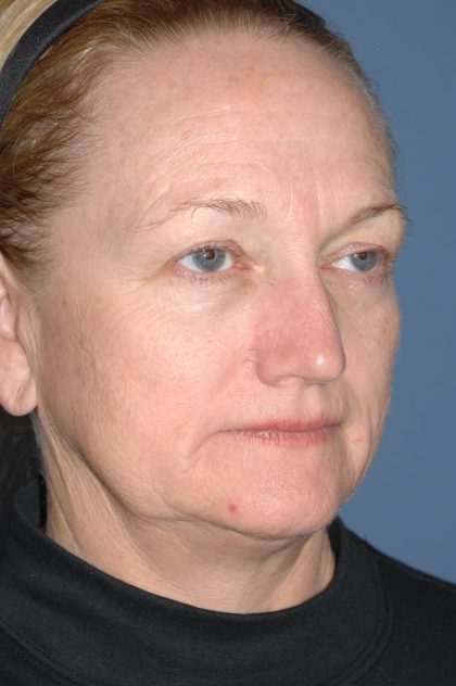 Upper & Lower Facelift - Brow Lift & Face/Neck Lift Before & After Patient #8305