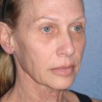 Upper & Lower Facelift - Brow Lift & Face/Neck Lift Before & After Patient #8026