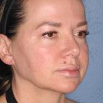 Upper & Lower Facelift - Brow Lift & Face/Neck Lift Before & After Patient #8028