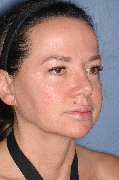 Upper & Lower Facelift - Brow Lift & Face/Neck Lift Before & After Patient #8028