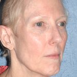 Upper & Lower Facelift - Brow Lift & Face/Neck Lift Before & After Patient #8029