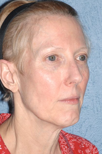 Upper & Lower Facelift - Brow Lift & Face/Neck Lift Before & After Patient #8029