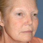 Upper & Lower Facelift - Brow Lift & Face/Neck Lift Before & After Patient #8030