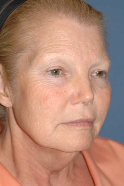 Upper & Lower Facelift - Brow Lift & Face/Neck Lift Before & After Patient #8030