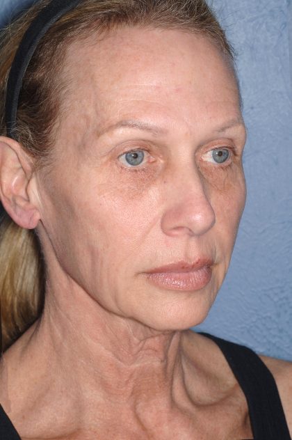 Upper & Lower Facelift - Brow Lift & Face/Neck Lift Before & After Patient #8026