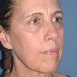 Upper & Lower Facelift - Brow Lift & Face/Neck Lift Before & After Patient #8031