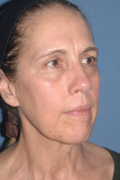 Upper & Lower Facelift - Brow Lift & Face/Neck Lift Before & After Patient #8031