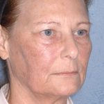 Upper & Lower Facelift - Brow Lift & Face/Neck Lift Before & After Patient #8032