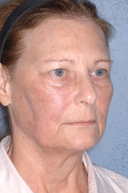 Upper & Lower Facelift - Brow Lift & Face/Neck Lift Before & After Patient #8032