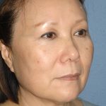 Upper & Lower Facelift - Brow Lift & Face/Neck Lift Before & After Patient #8033