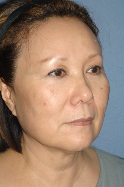 Upper & Lower Facelift - Brow Lift & Face/Neck Lift Before & After Patient #8033
