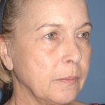 Upper & Lower Facelift - Brow Lift & Face/Neck Lift Before & After Patient #8034
