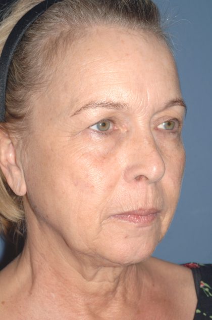 Upper & Lower Facelift - Brow Lift & Face/Neck Lift Before & After Patient #8034
