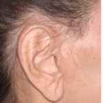 Facelift - Scar Before & After Patient #8170