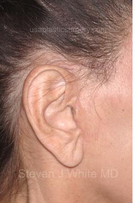 Facelift - Scar Before & After Patient #8170