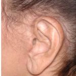 Facelift - Scar Before & After Patient #8170