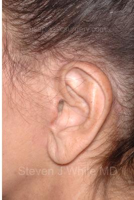 Facelift - Scar Before & After Patient #8170