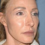 Upper & Lower Facelift - Brow Lift & Face/Neck Lift Before & After Patient #8027