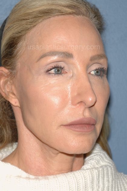 Upper & Lower Facelift - Brow Lift & Face/Neck Lift Before & After Patient #8027