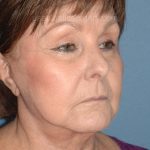 Upper & Lower Facelift - Brow Lift & Face/Neck Lift Before & After Patient #8301
