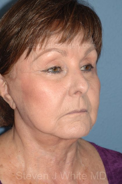 Upper & Lower Facelift - Brow Lift & Face/Neck Lift Before & After Patient #8301