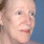 Upper & Lower Facelift - Brow Lift & Face/Neck Lift Before & After Patient #8303