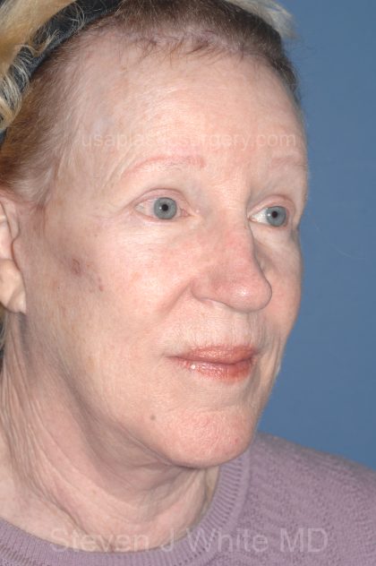 Upper & Lower Facelift - Brow Lift & Face/Neck Lift Before & After Patient #8303