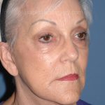 Upper & Lower Facelift - Brow Lift & Face/Neck Lift Before & After Patient #8302