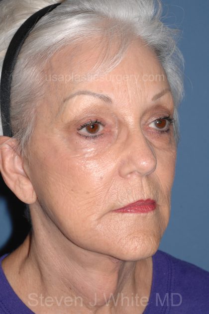 Upper & Lower Facelift - Brow Lift & Face/Neck Lift Before & After Patient #8302