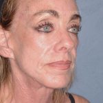 Upper & Lower Facelift - Brow Lift & Face/Neck Lift Before & After Patient #8304