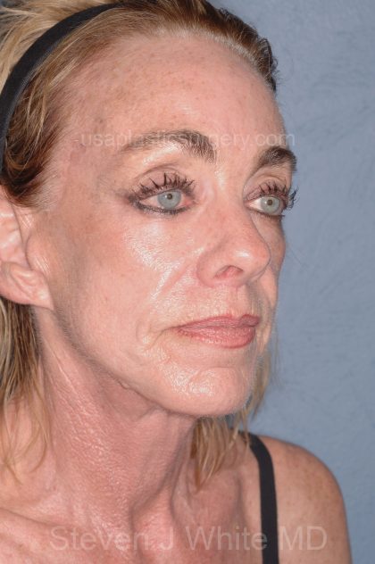 Upper & Lower Facelift - Brow Lift & Face/Neck Lift Before & After Patient #8304