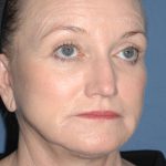 Upper & Lower Facelift - Brow Lift & Face/Neck Lift Before & After Patient #8305
