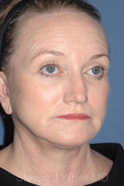 Upper & Lower Facelift - Brow Lift & Face/Neck Lift Before & After Patient #8305