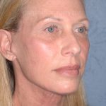 Upper & Lower Facelift - Brow Lift & Face/Neck Lift Before & After Patient #8026