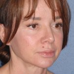 Upper & Lower Facelift - Brow Lift & Face/Neck Lift Before & After Patient #8028