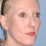 Upper & Lower Facelift - Brow Lift & Face/Neck Lift Before & After Patient #8029