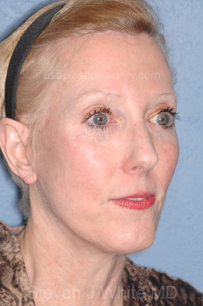 Upper & Lower Facelift - Brow Lift & Face/Neck Lift Before & After Patient #8029