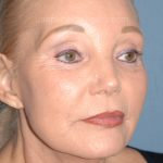 Upper & Lower Facelift - Brow Lift & Face/Neck Lift Before & After Patient #8030