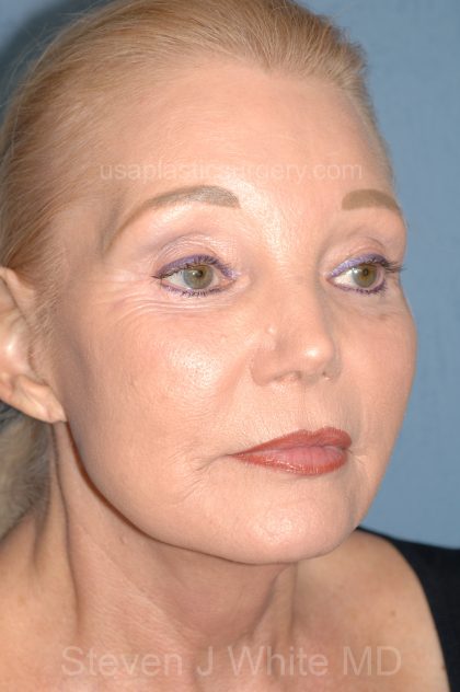 Upper & Lower Facelift - Brow Lift & Face/Neck Lift Before & After Patient #8030