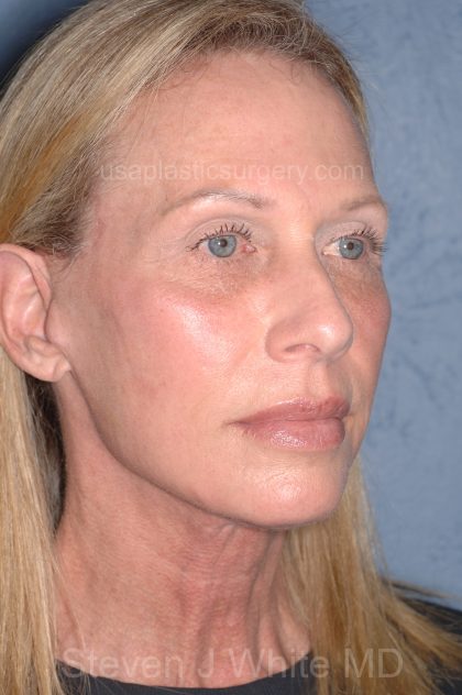 Upper & Lower Facelift - Brow Lift & Face/Neck Lift Before & After Patient #8026