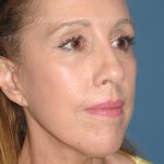Upper & Lower Facelift - Brow Lift & Face/Neck Lift Before & After Patient #8031