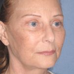 Upper & Lower Facelift - Brow Lift & Face/Neck Lift Before & After Patient #8032